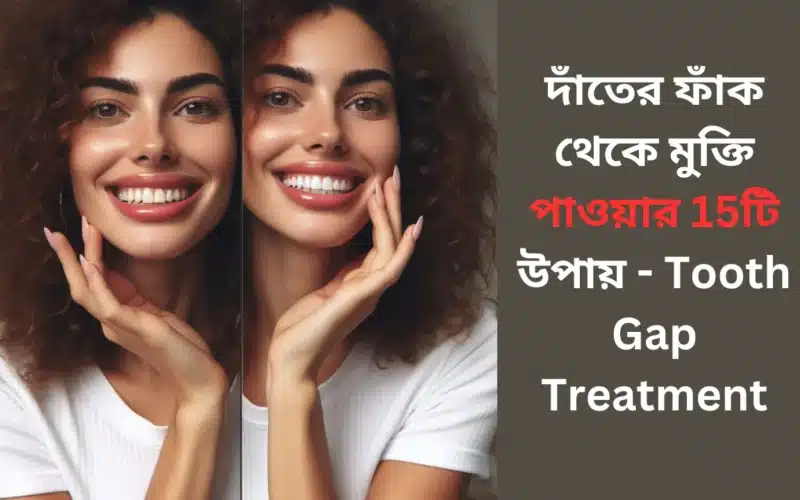 দাঁতের ফাঁক থেকে মুক্তি পাওয়ার 15টি উপায় – Tooth Gap Treatment